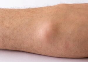 Lipoma come diagnosi differenziale di ernia della parete addominale