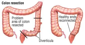 Resezione colica per diverticoli, sigmoidectomia