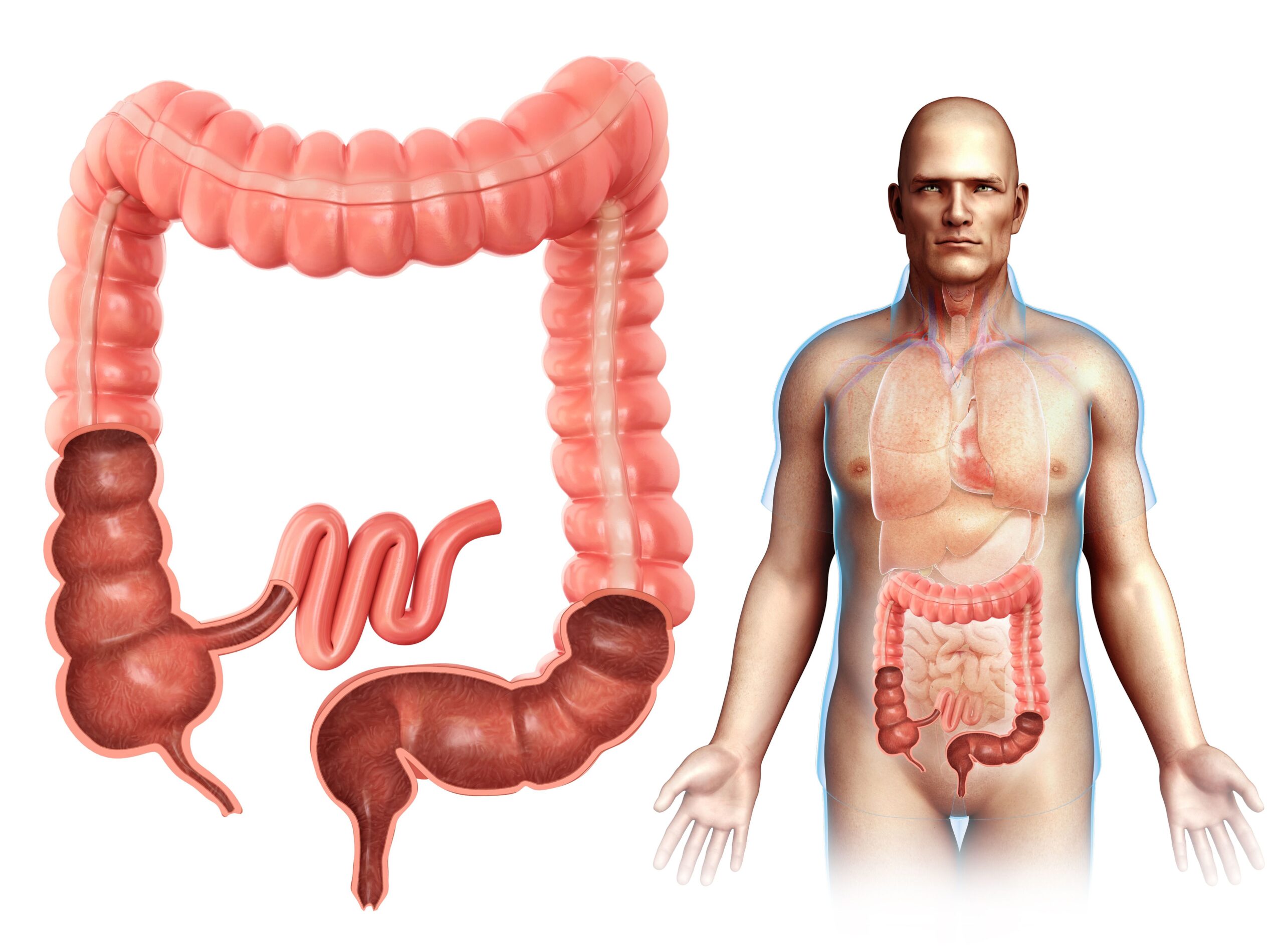tumore del colon