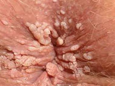 localizzazione anale di papilloma virus