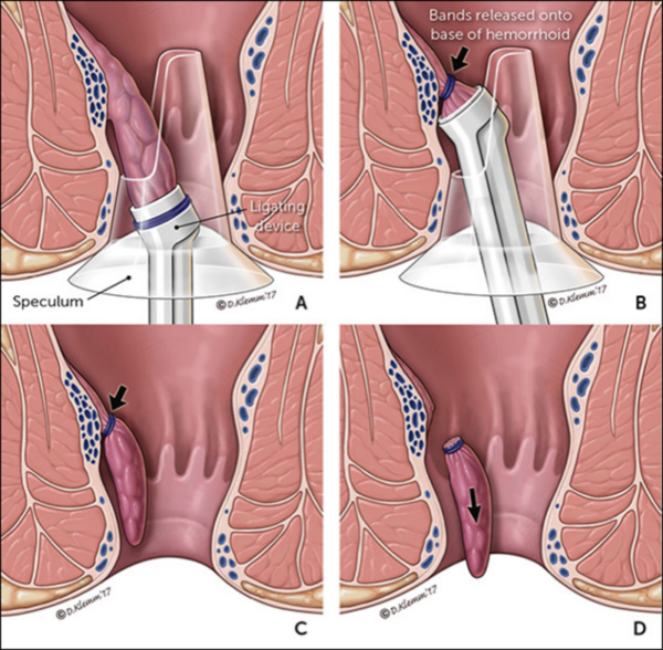 Proctologia ambulatoriale : tecnica legatura elastica emorroidaria